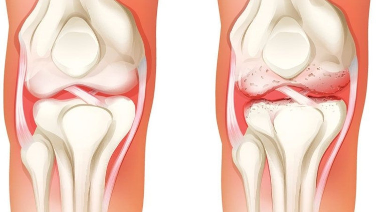 Diz kireçlenmesinin tedavisi bu yolla mümkün