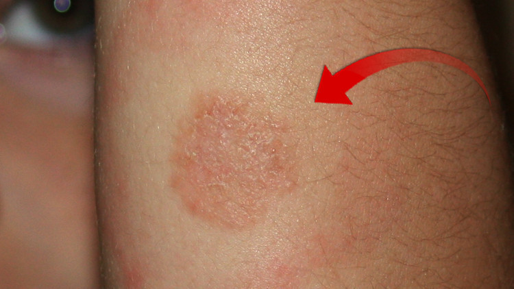 Kenelerden bulaşıyor, tedavi edilmezse tüm vücuda yayılıyor