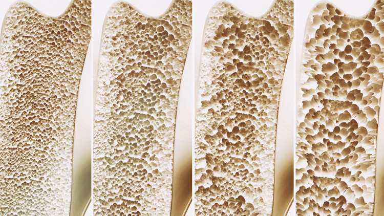 Hepsi kemiklerin düşmanı… Bu alışkanlıklarınızdan hemen vazgeçin