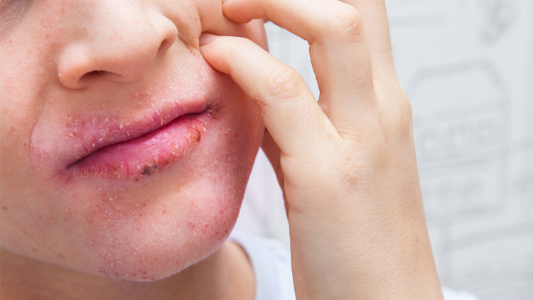 Hayati riski var Alerjik şok belirtilerini göz ardı etmeyin Hayati riski var Alerjik şok belirtilerini göz ardı etmeyin