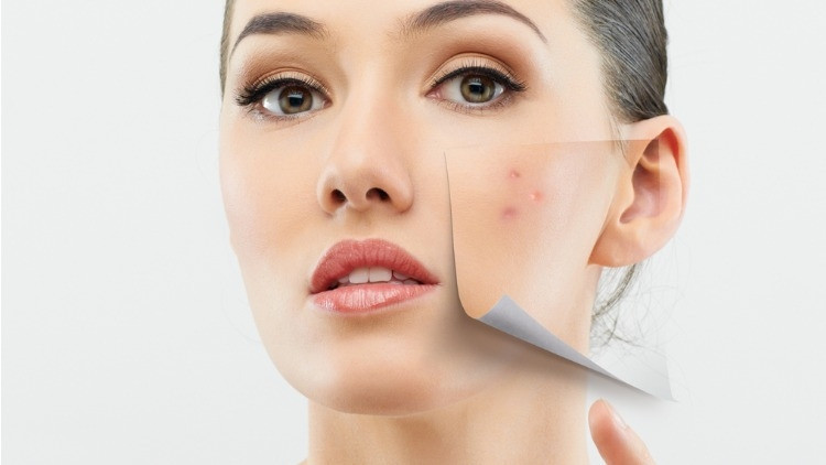 Sivilce izi nasıl geçer Sivilce izi tedavisi hakkında bilgiler