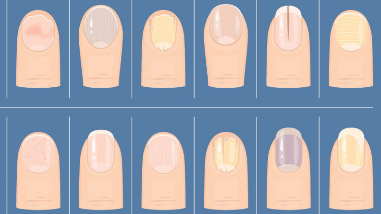 Bana tırnağını göster sana hastalığını söyleyeyim | Milyonlarca izlenen videodan sonra gündem tırnaklar... Bana tırnağını göster sana hastalığını söyleyeyim | Milyonlarca izlenen videodan sonra gündem tırnaklar...