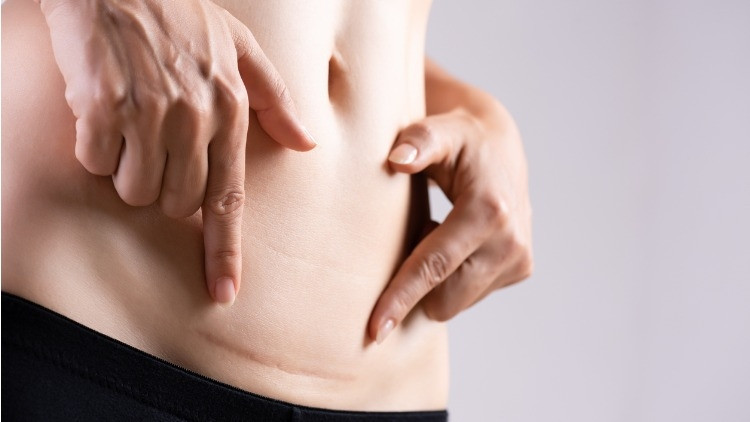 Labioplasti Nedir Labioplasti Ameliyatı Kimlere Yapılır, Tehlikeli Mi