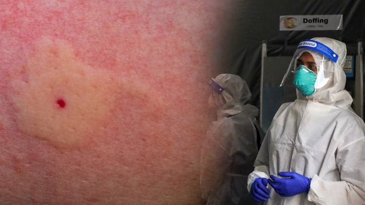 Koronavirüsü atlatanlarda saç boyasına karşı alerjik reaksiyon