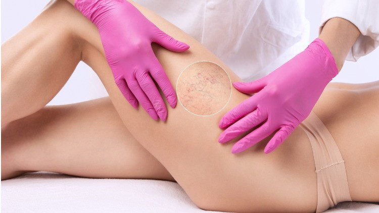 Peteşi nedir, neden olur Peteşi hastalığı belirtileri ve tedavisi Peteşi nedir, neden olur Peteşi hastalığı belirtileri ve tedavisi