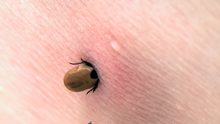 Lyme Hastalığı Nedir, Nasıl Bulaşır Lyme Hastalığı Belirtileri ve Tedavisi Lyme Hastalığı Nedir, Nasıl Bulaşır Lyme Hastalığı Belirtileri ve Tedavisi