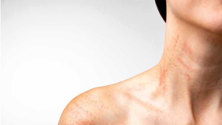 Ürtiker (Kurdeşen) nedir, neden olur Ürtiker belirtileri ve tedavi yöntemleri Ürtiker (Kurdeşen) nedir, neden olur Ürtiker belirtileri ve tedavi yöntemleri