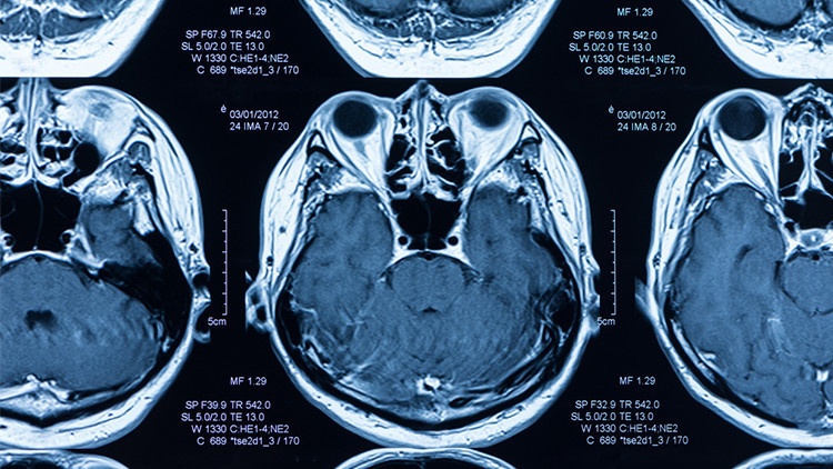 Herkesin konuştuğu ürkütücü araştırma Covid-19 beyni küçültüyor... Peki hafif geçirenler de etkileniyor mu Herkesin konuştuğu ürkütücü araştırma Covid-19 beyni küçültüyor... Peki hafif geçirenler de etkileniyor mu