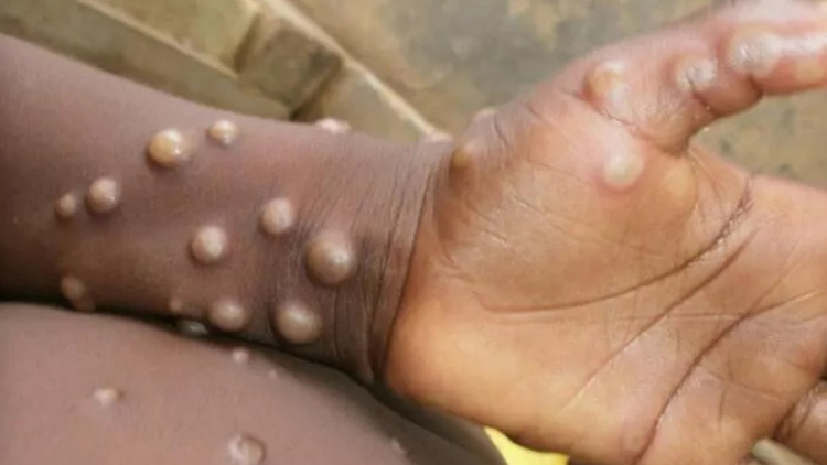 Tek tek açıklandı: Maymun çiçeği hangi ülkelerde görüldü Toplam vaka sayısı kaç Tek tek açıklandı: Maymun çiçeği hangi ülkelerde görüldü Toplam vaka sayısı kaç