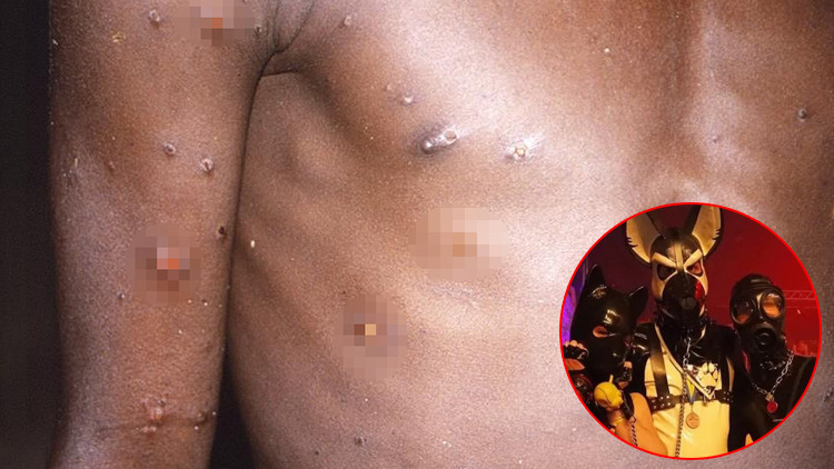 Maymun çiçeği paniği büyüyor: Hastalık fetiş festivalinden yayılmış Maymun çiçeği paniği büyüyor: Hastalık fetiş festivalinden yayılmış