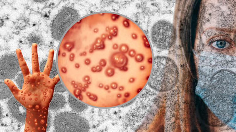 ABDde Maymun çiçeği virüsü alarmı... CDCden flaş açıklama geldi