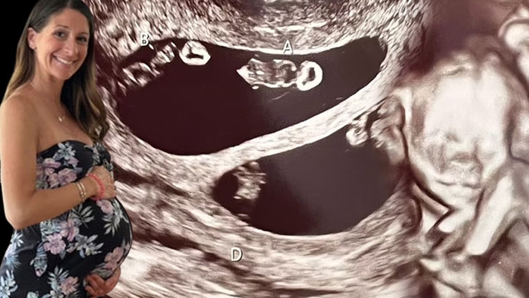 Ultrasona giren anne adayı hayatının şokunu yaşadı 70 milyonda bir görülüyor...