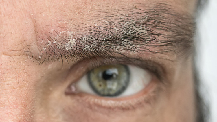 Dikkat Yaz aylarında sıklığı arttı... Kaş kepeği kaş kaybına bile neden oluyor