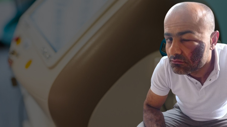 İstenmeyen tüyler için en etkili çözüm ama... Herkesin başına gelebilir