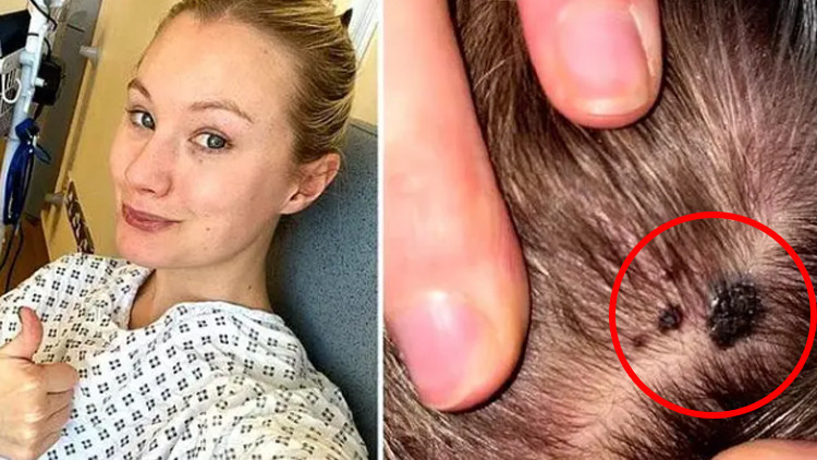 Kafasında çıkan benler için mantar teşhisi aldı, gerçek hastalığının melanom olduğu ortaya çıktı Kafasında çıkan benler için mantar teşhisi aldı, gerçek hastalığının melanom olduğu ortaya çıktı