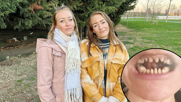 Danimarkalı ikizlerin diş tedavisi kabusa döndü Dişlerinden oldular Danimarkalı ikizlerin diş tedavisi kabusa döndü Dişlerinden oldular