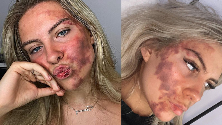 Her şey dudağındaki küçük bir sivilce ile başladı... Doktorlar teşhis koyamıyor... Her şey dudağındaki küçük bir sivilce ile başladı... Doktorlar teşhis koyamıyor...