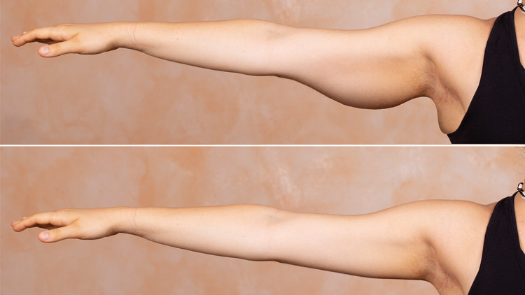 Op. Dr. Bülent Cihantimur yazdı: Zayıflama sonrası sarkan deriler ve ne yapmalı