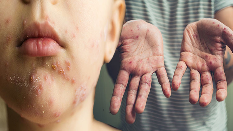 Dikkat, el ayak ağız hastalığı artıyor Özellikle çocukları hedef alıyor... ‘Sıkça karşılaşmaya başladık, çok çabuk bulaşıyor