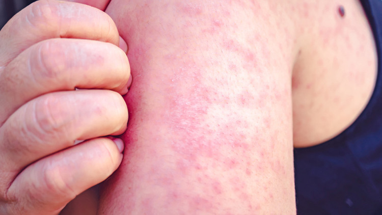 10 SORUDA KIZAMIK DOSYASI I Çocuklardan sonra yetişkinler de risk altında Peki nasıl korunacağız