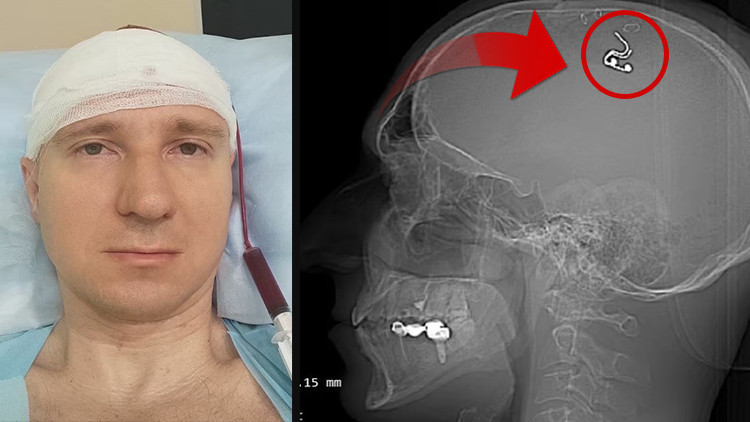 Rüyalarını kontrol etmek için kafasını matkapla deldi Yaşadığım için mutluyum ama ölmeye hazırdım