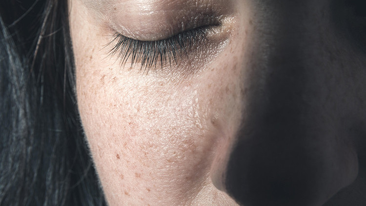 Doktorlar çilimi egzama zannetti, 4üncü evre kanser çıktı... Hangi lekeler tehlikeli Nasıl ayırt edeceğiz Doktorlar çilimi egzama zannetti, 4üncü evre kanser çıktı... Hangi lekeler tehlikeli Nasıl ayırt edeceğiz