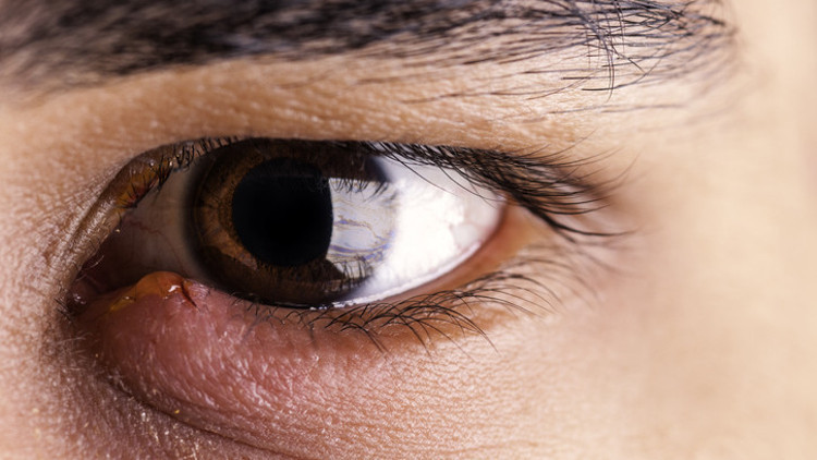 Kullandığı deneme ürününden bulaşan bakteri yüzünden geçici görme kaybı yaşadı... Göz selüliti ciddi vakalarda göz kaybına bile neden olabilir