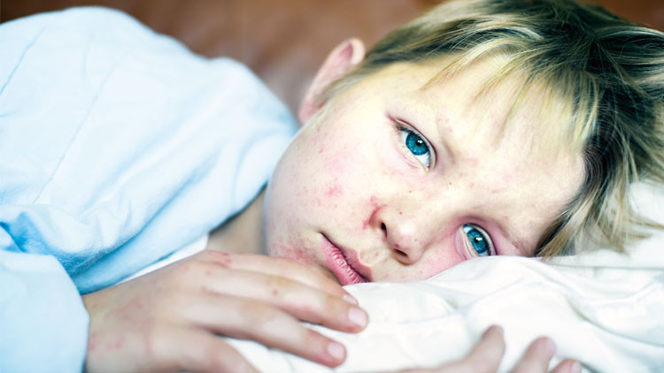 Avrupa’da kızamık alarmı