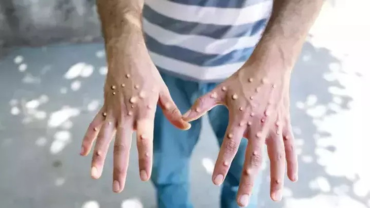 Türk İlaç, Mpox ilacı için distribütörlük anlaşması yaptı Türk İlaç, Mpox ilacı için distribütörlük anlaşması yaptı