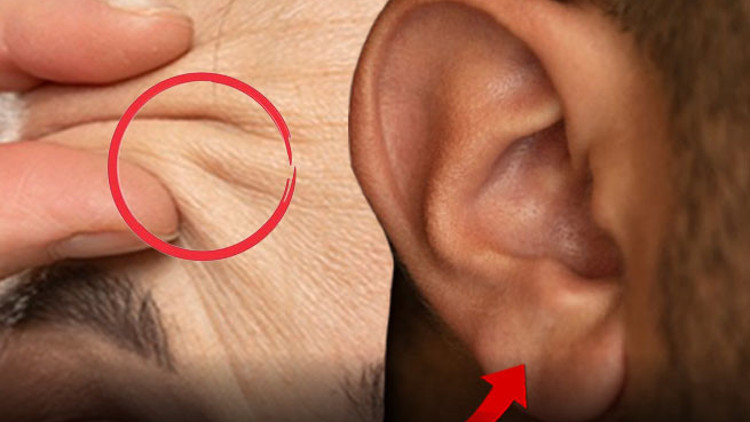 Alnınızda ya da kulağınızda bu çizgiler varsa dikkat Vücuttaki bazı değişimler kalp hastalıkları hakkında uyarıcı olabilir... Özellikle genç yaşlarda görülürse...