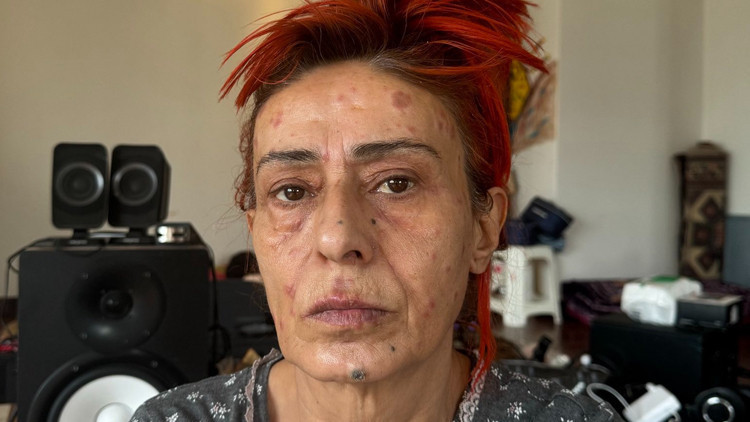 Yıldız Tilbenin yüzünde yanıklar oluştu... Görüntüsü korkuttu