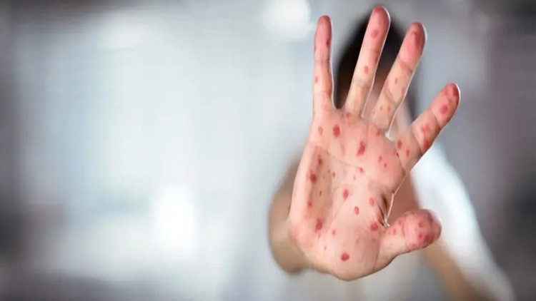 ABDde kızamık alarmı: Vaka sayısı 624e yükseldi