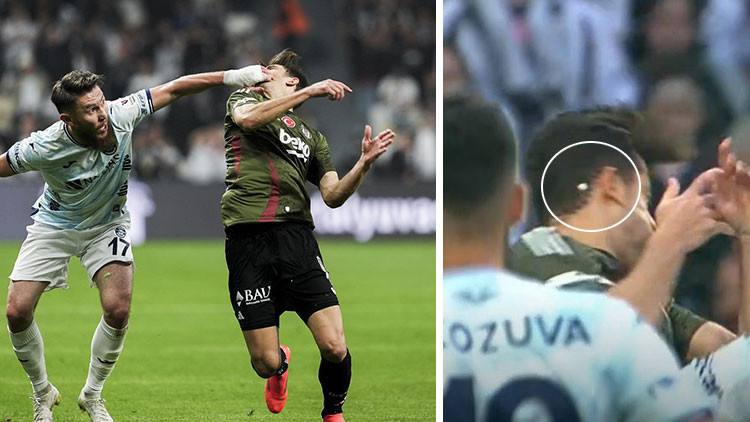 Beşiktaşta sakatlıklar tat kaçırdı Yıldız oyuncunun dişi kırıldı