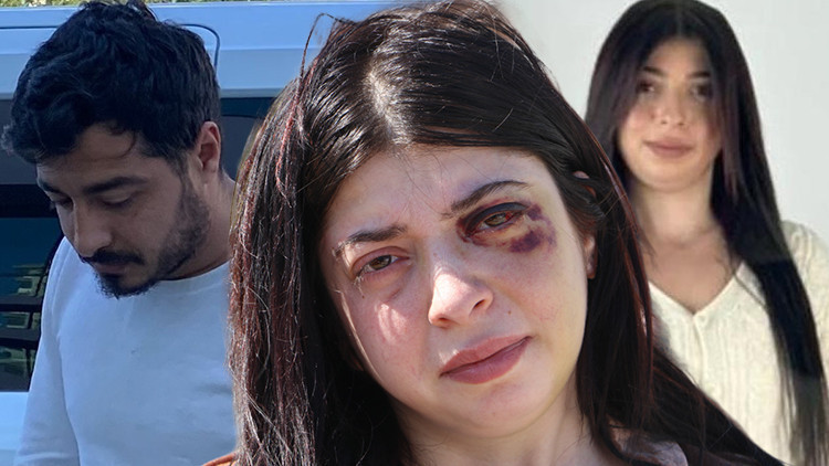 Sokak ortasında dehşeti yaşamıştı: Yüzümde bir demirle sonsuza dek yaşamaya mahkum bırakıldım