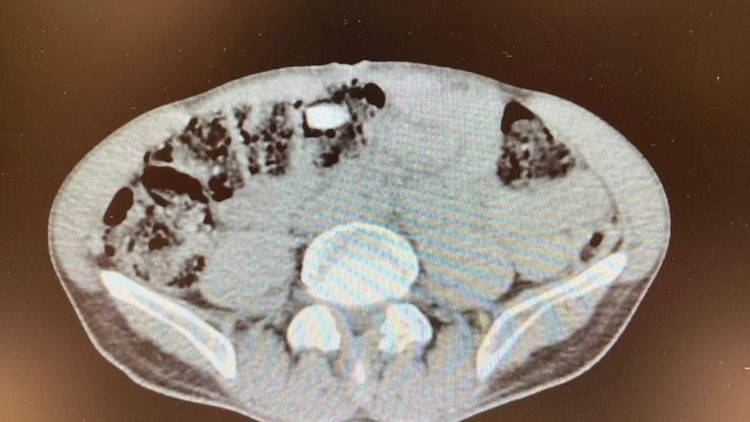 Midesinde uyuşturucu çıkan şüpheli tutuklandı