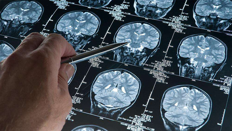 Alzheimerda yeni umut: Erken evrede teşhisi mümkün kılacak kan testi ABDde onaylandı Alzheimerda yeni umut: Erken evrede teşhisi mümkün kılacak kan testi ABDde onaylandı