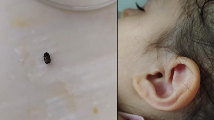 3 yaşındaki çocuğun kulağına kene yapıştı İzmitte kene alarmı