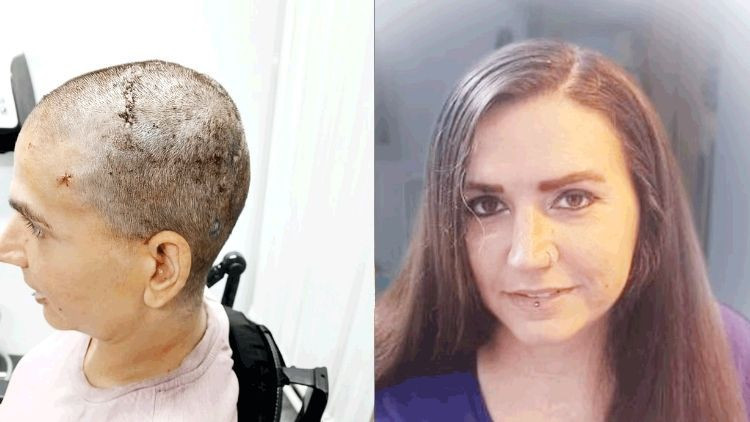 Neuralink mucizesi… Felçli kadın 20 yıl sonra adını yazdı