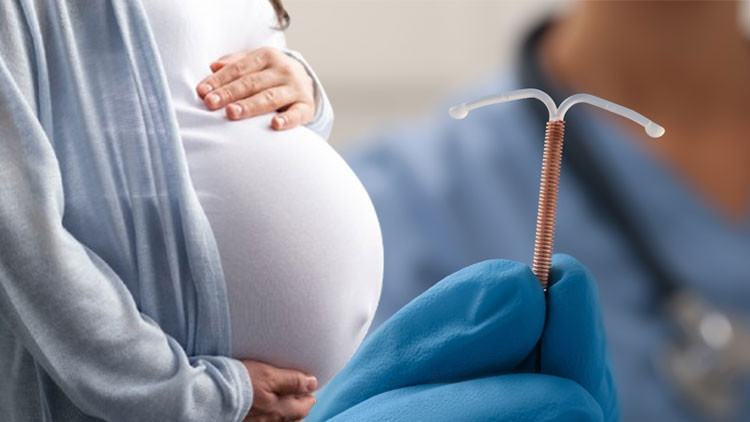 Tüplerini bağlatan kadın hamile kaldı Dünyanın başka yerlerinde ise bebekler ellerinde spiral ile doğuyor... ‘En güvenilir’ olduğu söylenen korunma yöntemleri neden korumuyor Tüplerini bağlatan kadın hamile kaldı Dünyanın başka yerlerinde ise bebekler ellerinde spiral ile doğuyor... ‘En güvenilir’ olduğu söylenen korunma yöntemleri neden korumuyor