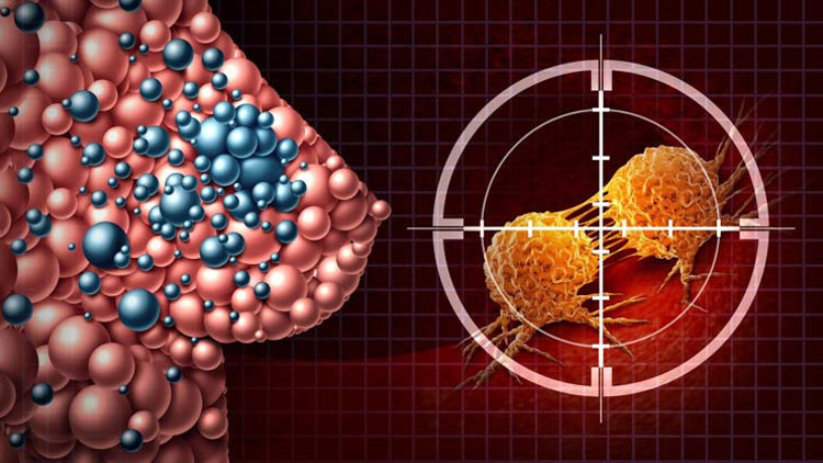 Vakaların yüzde 80’inde aile öyküsü yok, üstelik çoğu zaman ağrısız ortaya çıkıyor! Meme sağlığı konusunda doğru bilinen yanlışlar