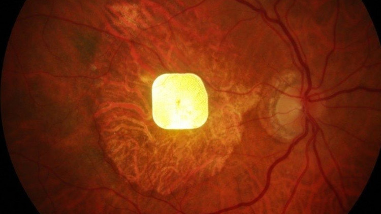 Görmeyi geri getiren çip: PRIMA ile yeniden okumak mümkün