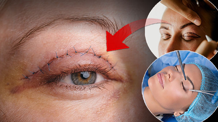 Basit bir operasyon diye girdi, şimdi bir gözünü tam kapatamıyor | 6 SORUDA GÖZ KAPAĞI ESTETİĞİ