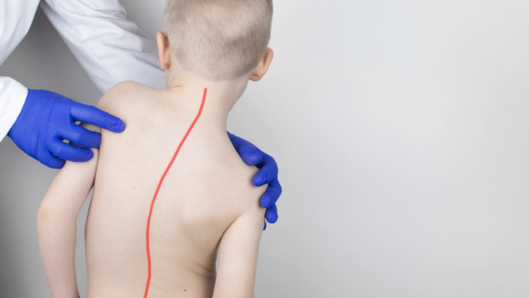 Çok önemsenmiyor ama aslında bir halk sağlığı sorunu... Skolyoz vakaları özellikle çocuklarda ve ergenlerde artıyor