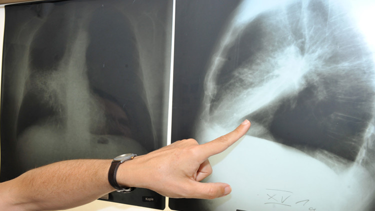 Gençlerde kanser oranı artıyor Gençlerde kanser oranı artıyor