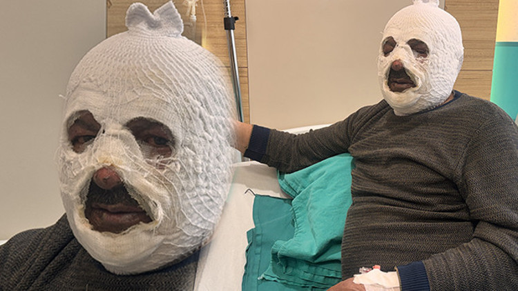 Arkadaşına yardım etmek istedi: Az daha canından oluyordu Ben yandım kimse yanmasın Arkadaşına yardım etmek istedi: Az daha canından oluyordu Ben yandım kimse yanmasın