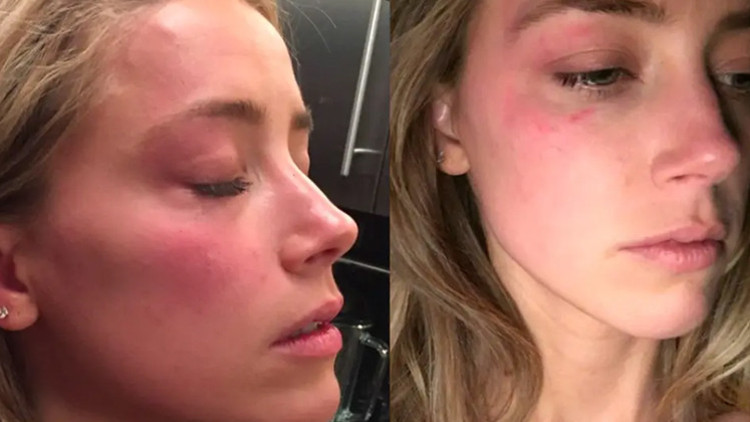 Büyük aşkla evlendiği kocasından şiddet görünce boşanmıştı... Konuşma yeteneğimi kaybettim... Hikayemi anlatmak istemiyorum Büyük aşkla evlendiği kocasından şiddet görünce boşanmıştı... Konuşma yeteneğimi kaybettim... Hikayemi anlatmak istemiyorum