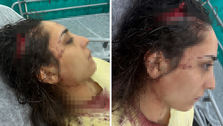 Bakkala giden genç kadın sokak köpeklerinin saldırısına uğradı