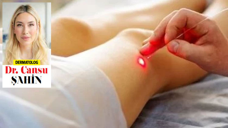 Bilimsel bir tedavi: Fraksiyonel lazer Bilimsel bir tedavi: Fraksiyonel lazer
