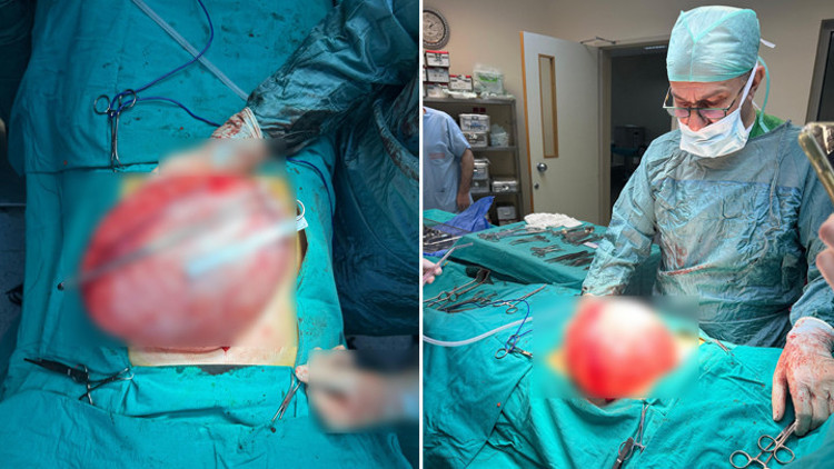 Boluda kilo vermek için hastaneye giden 14 yaşındaki çocuğun karnından 3,5 kiloluk kist çıktı