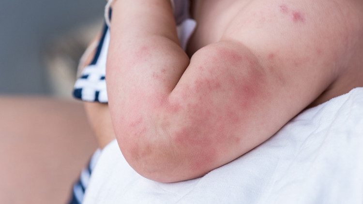 Milyonlarca çocukta görülüyor! En riskli grup 5 yaş altındakiler